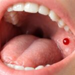 découvrez comment éliminer efficacement une boule de sang dans la bouche, les causes possibles et les précautions à prendre pour éviter les complications.