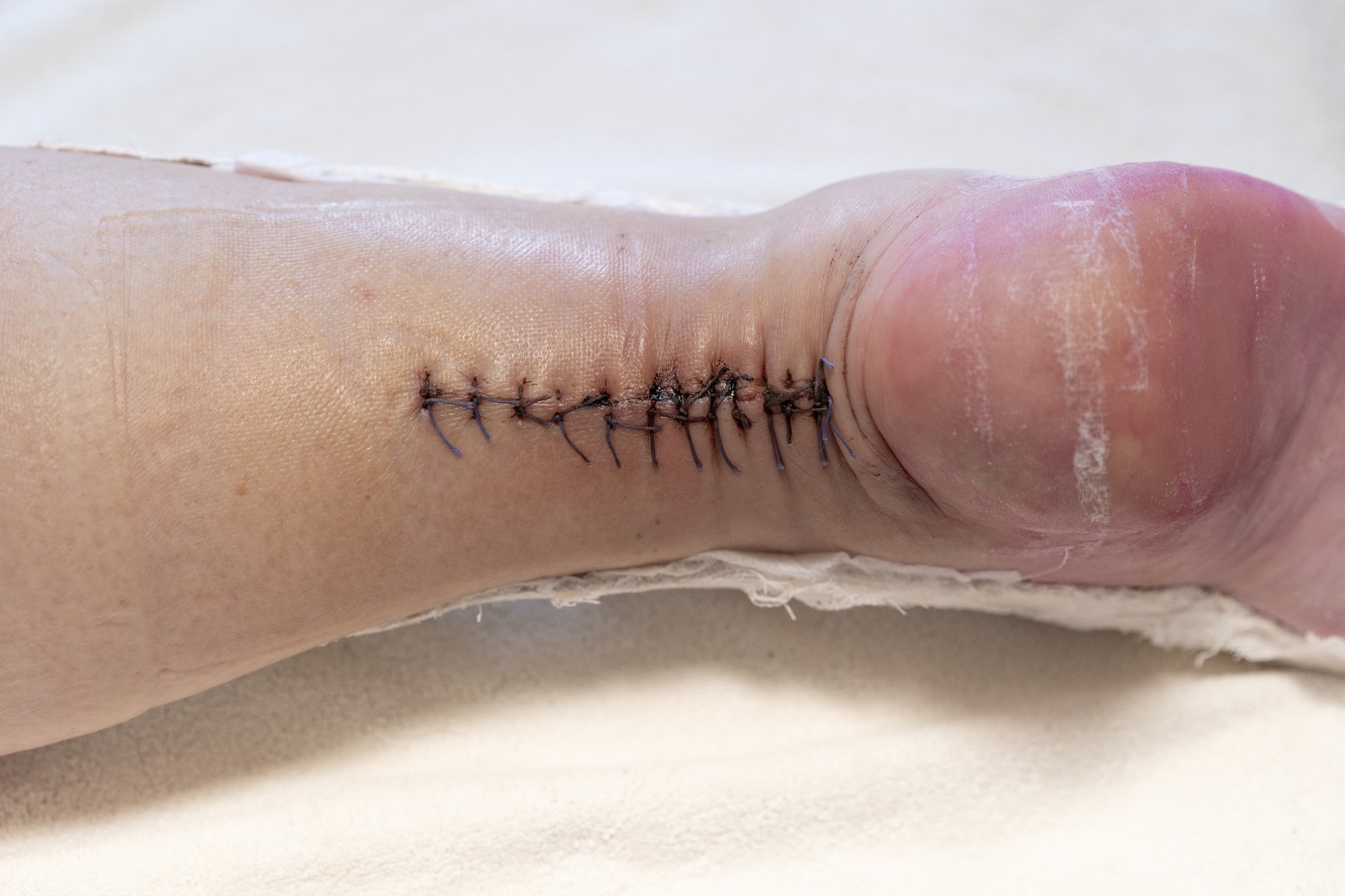 Surgical suture on the leg